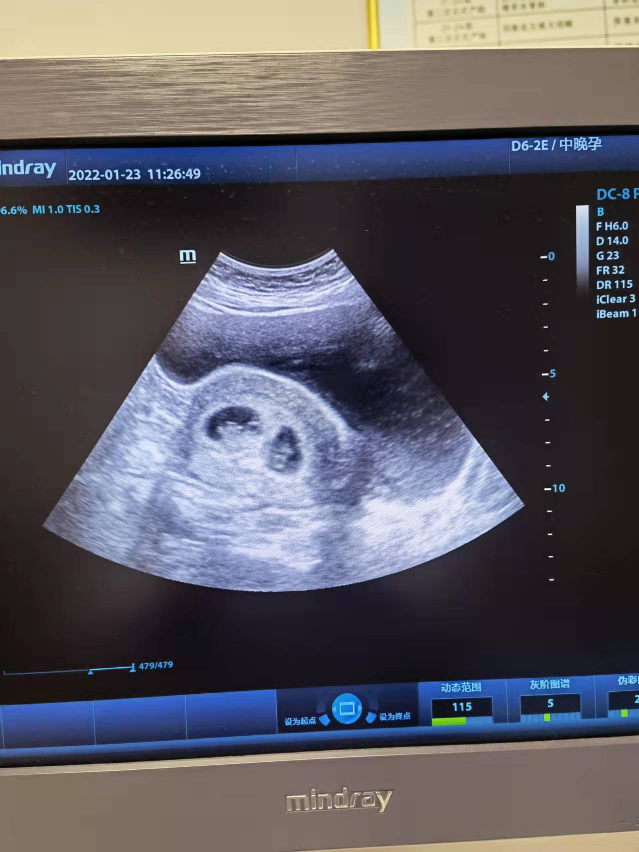 三年未孕，治疗一月成功怀孕双胞胎.jpg